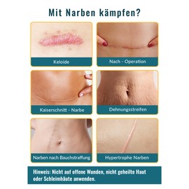 Silikon Narbenpflaster(4cm x 300cm), Wiederverwendbar Silikonpflaster für C-Section-Narben, Operationsnarben, Verbrennungsnarben und Ähnliche Geeignet