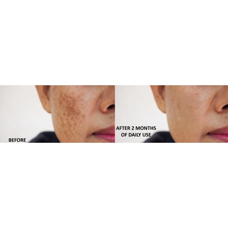 APLB Tranexamic Acid Niacinamide Cream & Serum Combo Melasma Dark