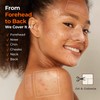 TKTK Pimple Patches for Face, 6 Sizes Hydrocolloid Acne Patch