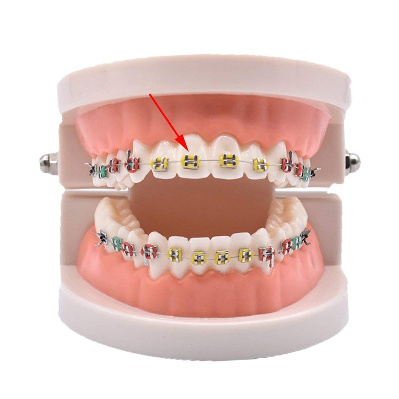 Chargenyang 1040pcs Orthodontic Ligature Ties Multi-Color Orthodontic Elastomeric O-Rings Braces