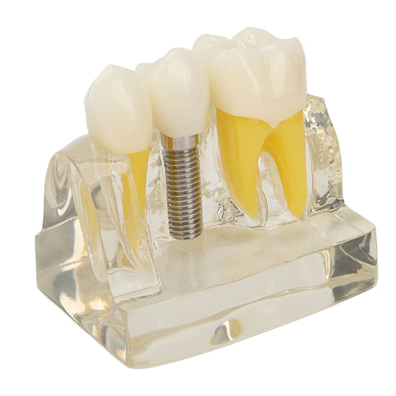 Teeth Implant Model Transparent Dental Teaching Research Demonstration Teeth Model