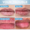 Belani Fordyce Seeds - Lip Acne, Moisturizes, Improves Dry, Chapped