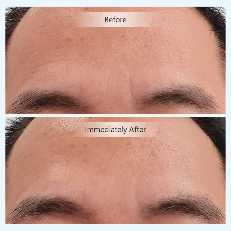 Youth Activating Instant Filler