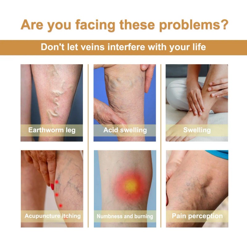 Crema Para Venas Varicosas,alivia Dolor Y Eliminar Varices*2