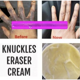 Unbranded DARK KNUCKLES  SKIN WHITENING LIGHTENING KOJIC ACID, GLYCOLIC ACID FACE CREAM .