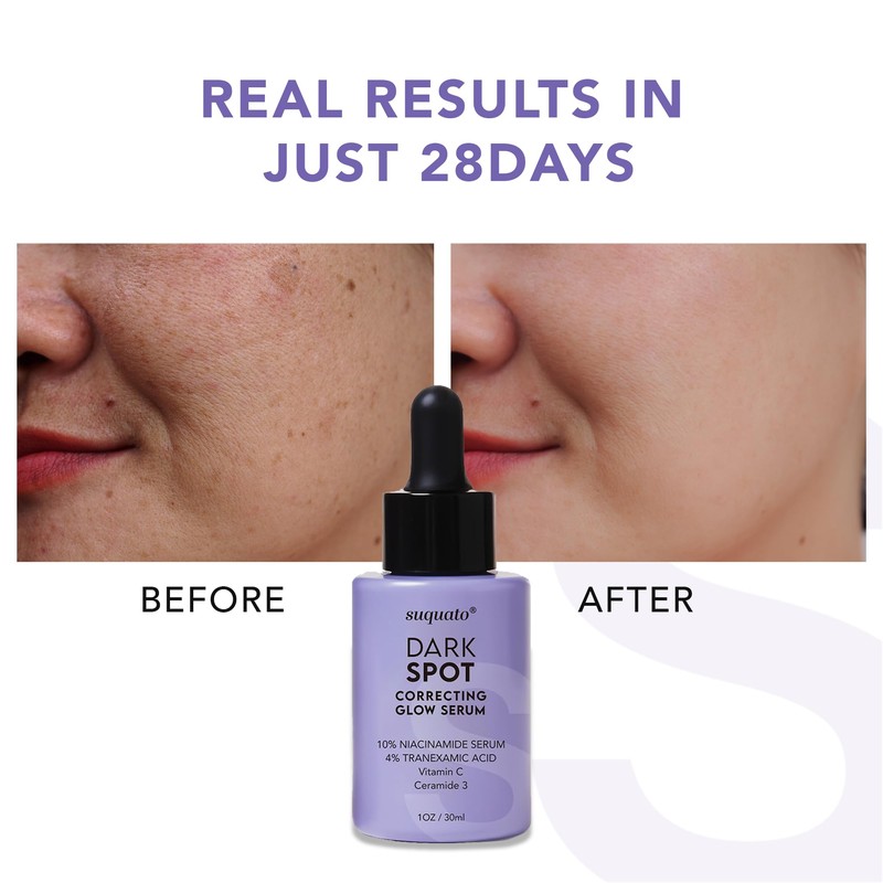 Dark Spot Correcting Glow Serum: Melasma Hyperpigmentation Treatment for Face