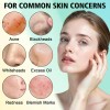 Tratamiento Para El Acné Facial, Crema Antiacné, Crema Para