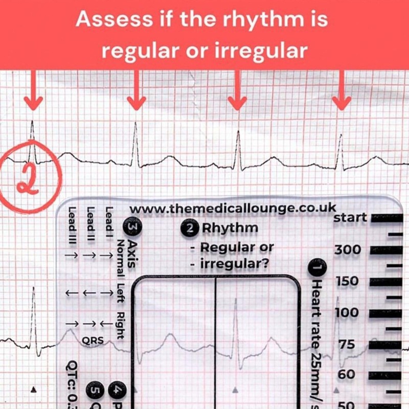 ECG RULER Pocketcard - Transparent EKG Calipers 7 Step Ruler