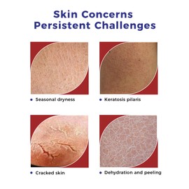 Urea Cream 42 Percent, Callus Remover Foot Cream, 42% Urea Cream for Dry, Cracked Feet, Anti Callus Foot Cream for Heels, Elbows - Anti Callus Cream, Urea Foot Cream for Foot Care