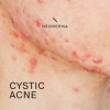 SUPPLEMENTS4ME ACNE QUISTICO SOLUCION HOMBRES Y MUJERES - Made in