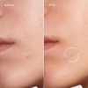 MAREE Pimple Patches for Face -Acne Clearing Device-Clear Acne Patches