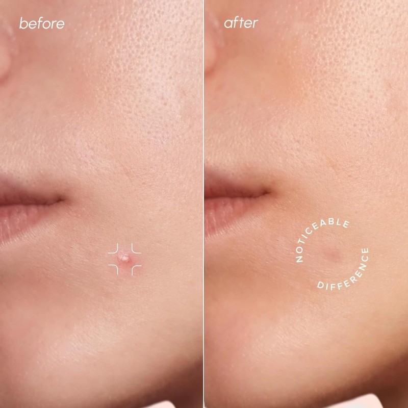 MAREE Pimple Patches for Face -Acne Clearing Device-Clear Acne Patches