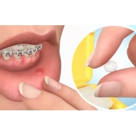 GUM Cera Para Brackets / Ortodoncia Gum® + Vitamina E (6 Piezas)