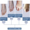 Bunion Corrector and Toe Straightener & Adjustable Orthopedic Pneumatic Bunion