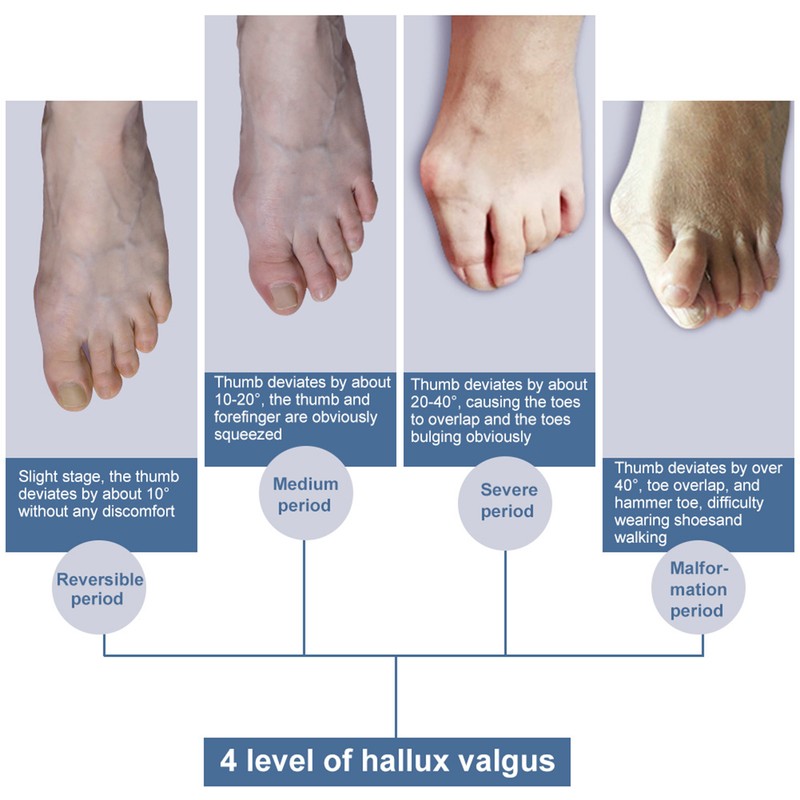 Bunion Corrector and Toe Straightener & Adjustable Orthopedic Pneumatic Bunion