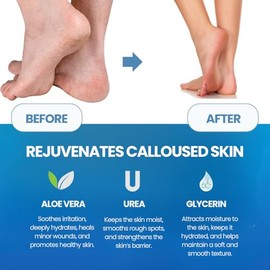 Imperial Feet Callus Remover Set - Extra Strength Spray & Foot File