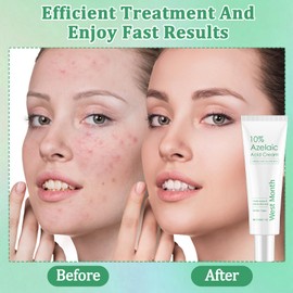 Azelaic Acid Serum 10% Azelaic Acid Serum Balance Face Oils Mild and Non-Irritating Anti Pimples and Nodules Relieves Face Redness for a Variety of Skin Types (30 g)