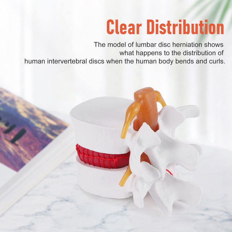 TOBEOME 1:1.5 Human Demonstration Model for Herniated Disc of the