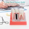 LVCHEN Modelo de implante dental – 4 veces corona puente
