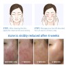 Bioaqua crema antiacné controla grasa y manchas, uso diario facial