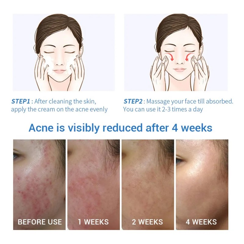Bioaqua crema antiacné controla grasa y manchas, uso diario facial