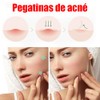 LUHI 200PCS Parches para Acne, Pimple Patch, Parches para Espinillas