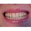 2 Thermo-molding Custom Fitting Whitening Trays