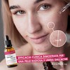 Serum Acne Essenze.me - Trattamento Anti-Acne Veloce, Elimina Brufoli e