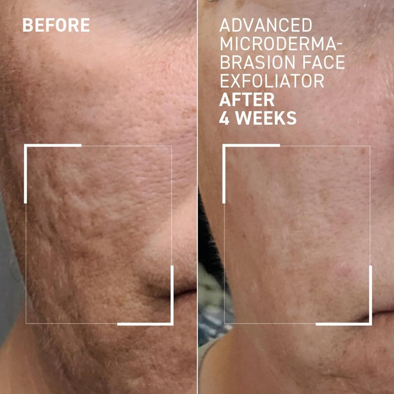 Dr. Brandt Advanced Microdermabrasion Face Exfoliator Travel Size - 0.7