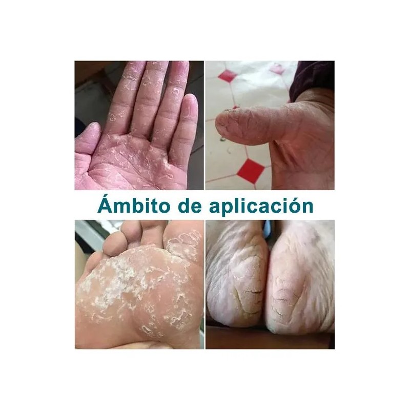Artken Reparación Para Pies Agrietados Y Resecos - Crema T