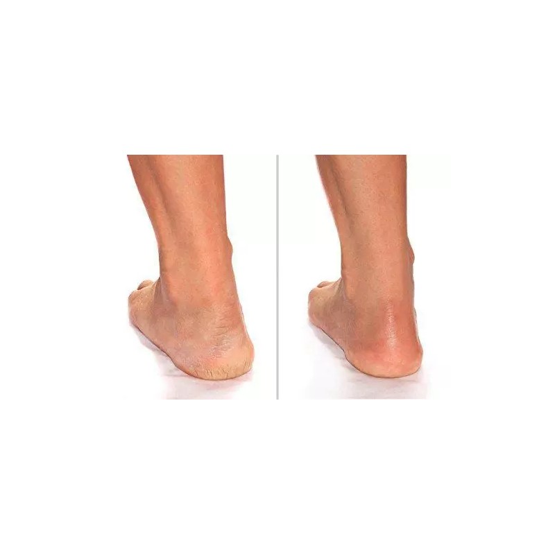 Advanced Clinicals Cracked Heel Cream For Dry Feet, Rough Spots,