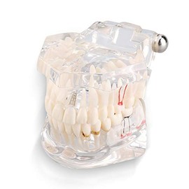 Modelo de Dientes dentales, Modelo de Dientes de implante Dental, Modelo de Dientes de demostración Dental, Adecuado para oficinas dentales, presentaciones legales y programas de