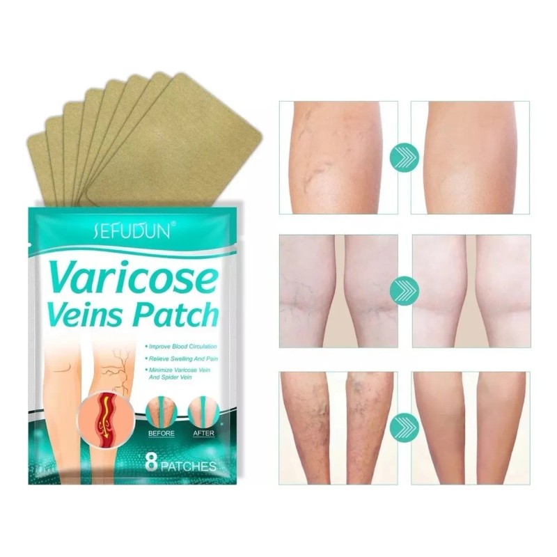 Parche para Aliviar el Dolor de Venas Varicosas y Varices