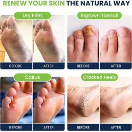 Foot Cure Remojo De Pies Con Sales De Epsom, Paquete Variado