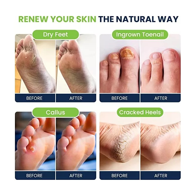 Foot Cure Remojo De Pies Con Sales De Epsom, Paquete