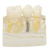 Teeth Implant Model Transparent Dental Teaching Research Demonstration Teeth Model
