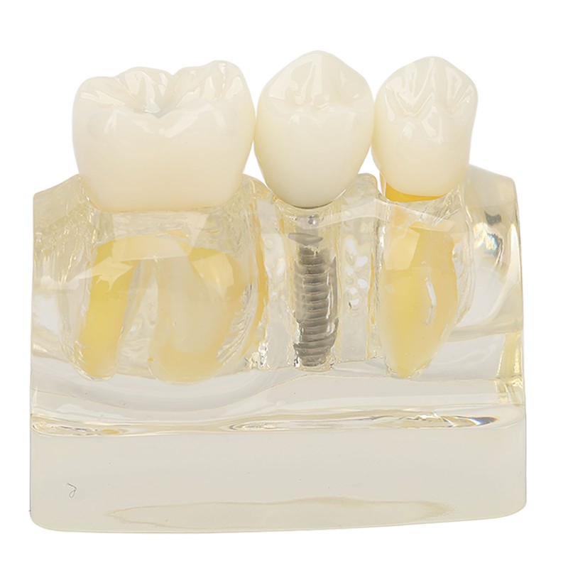 Teeth Implant Model Transparent Dental Teaching Research Demonstration Teeth Model