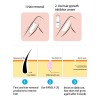 Bikini Para Barba Permanente, Inhibidor Del Crecimiento Del