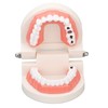 Dental Disease Caries Teeth Model Resin Simulation Teaching Prop Dental