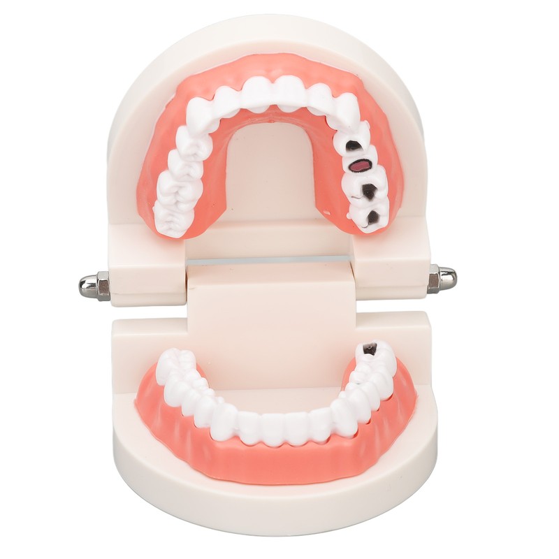 Dental Disease Caries Teeth Model Resin Simulation Teaching Prop Dental