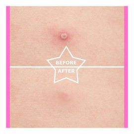 Auslka Parches De Espinilla De Estrella, 156 Parches, Puntos