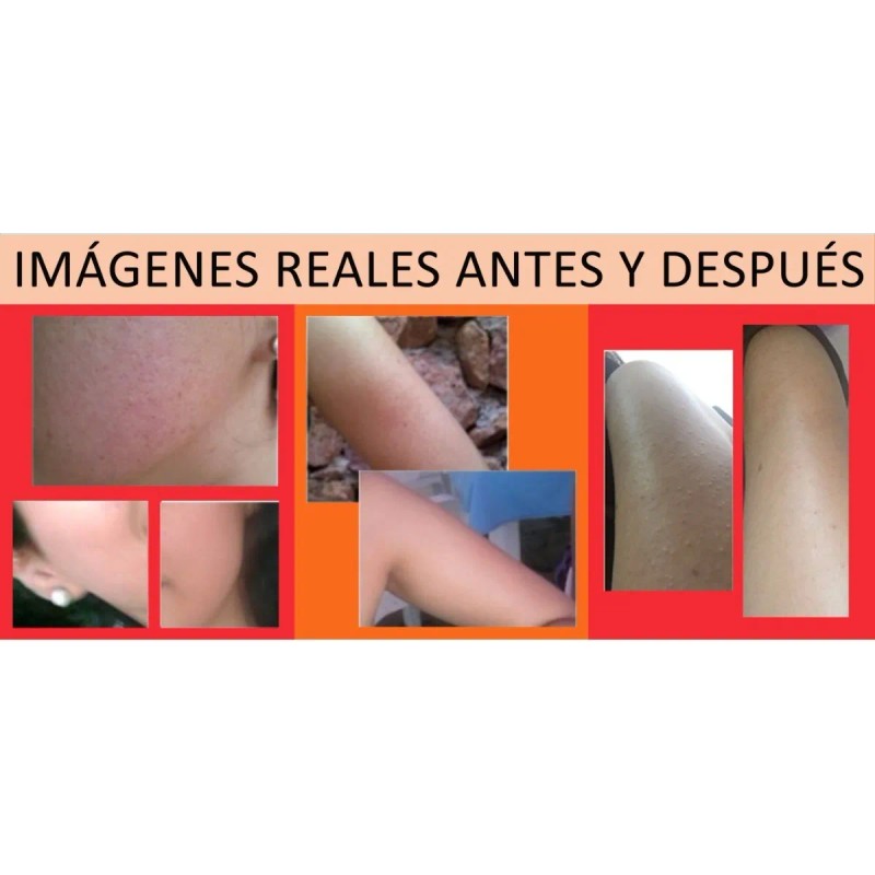 Crema Quera (queratosis, Psoriasis Y Eccema) 250 Gramos