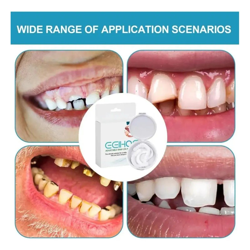 Dientes Postizos Temporal Sonrisa Dental Carilla