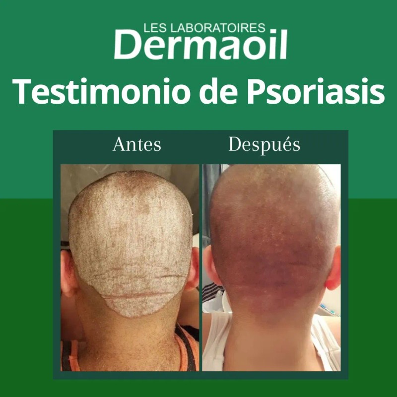 Shampoo Terapéutico Natural Alivio Para Psoriasis Capilar