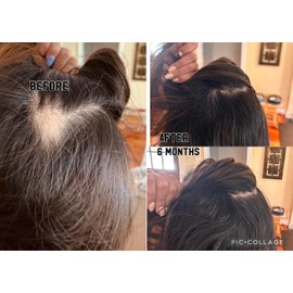 Suero para el cuero cabelludo de Pelo Naturals Suero para el crecimiento del cabello para mujeres y hombres Ideal para la caída y debilitamiento del cabello Favorece el crecimiento del cabello