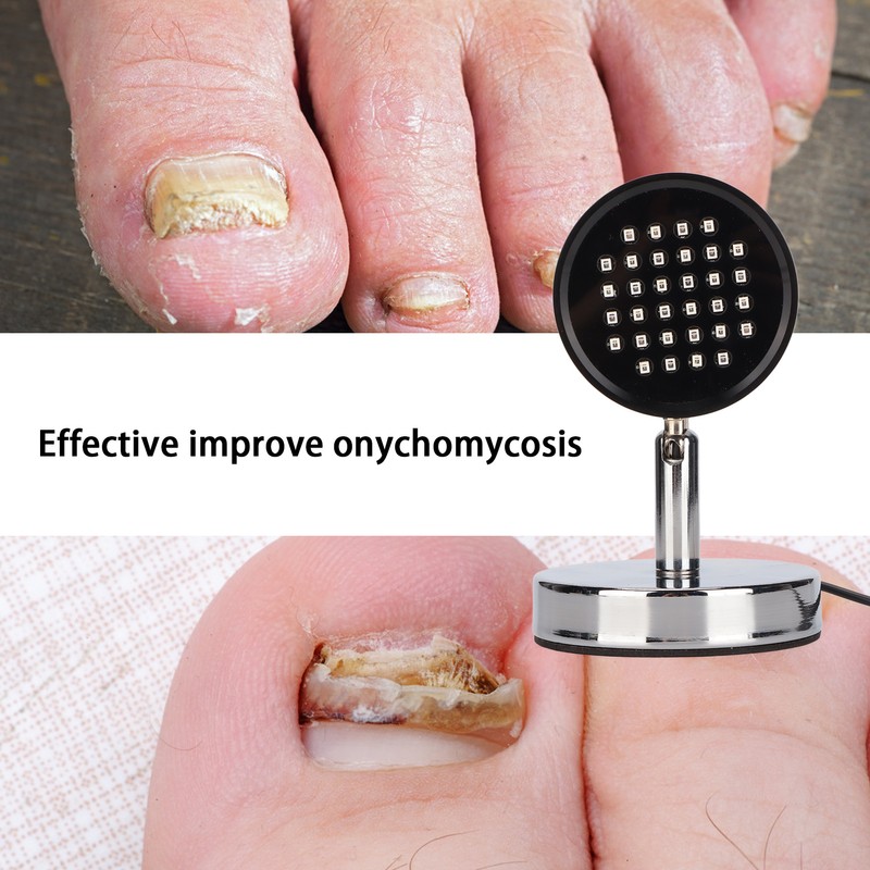 Onychomycosis Treatment Light Toenail Fingernail Care Painless Onychomycosis Remover Device
