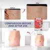 HSFIYAKJ Hydrocolloid Patches, 144 Pcs