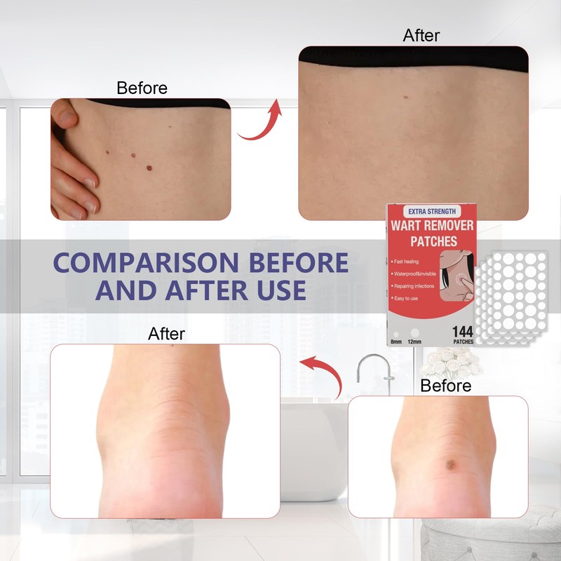 HSFIYAKJ Hydrocolloid Patches, 144 Pcs