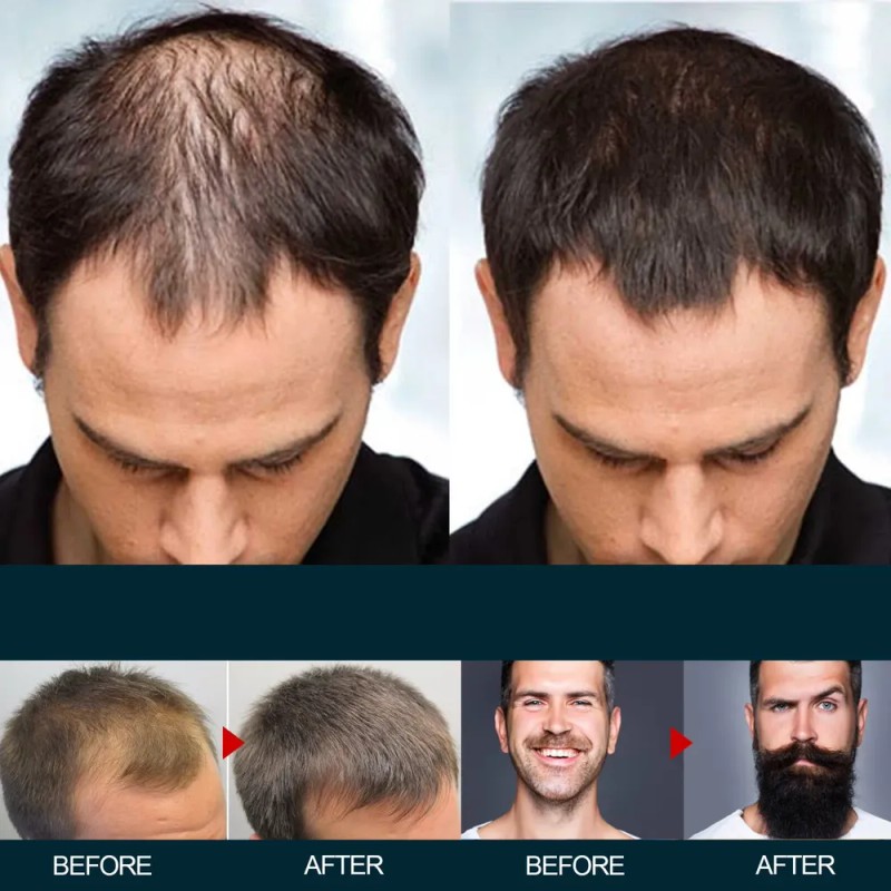 Tratamiento East Moon Para Crecimiento De Pelo Y Barba, .