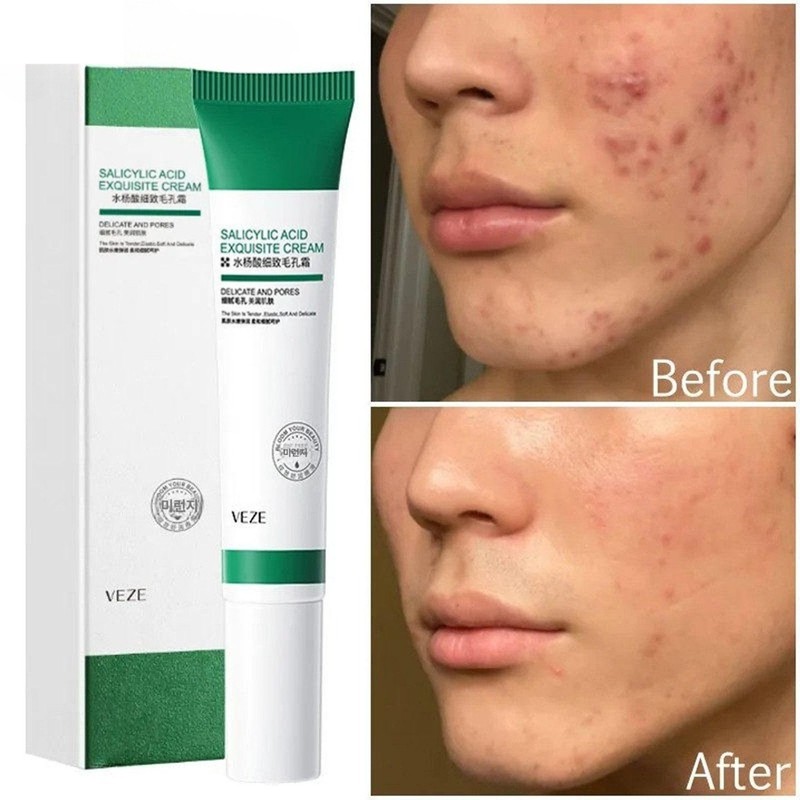 블랙헤드 모공수축 기미개선 아크네 크림 살리실산 아젤라익산 Blackhead Pore Tightening